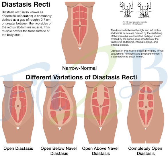 diastasis